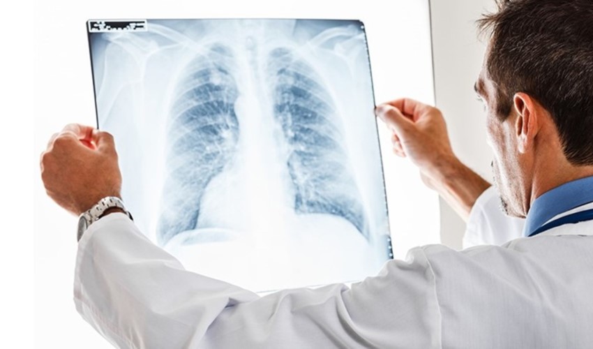 Araştırma: Akciğer kanserinin en büyük nedeni belli oldu