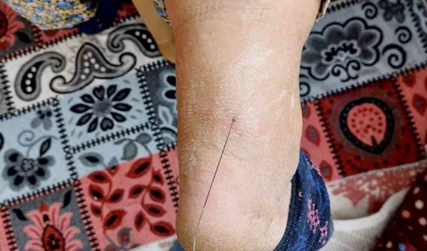 Estratto un filo metallico di 37 centimetri dal tallone! Altri 5 frammenti di filo sono presenti nel suo corpo