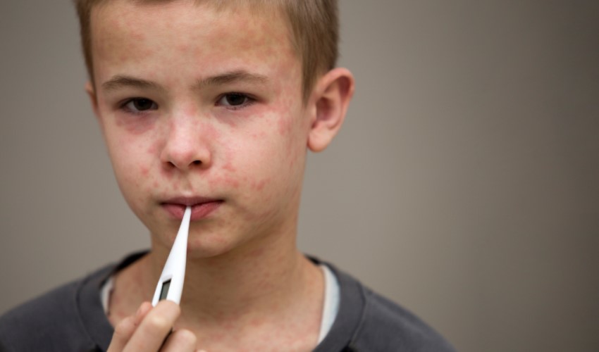 Grande aumento dei casi di morbillo