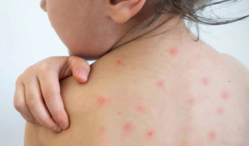 Kızamık vakalarında korkutan artış:  ‘Aşı karşıtlığı toplum sağlığını tehdit ediyor’