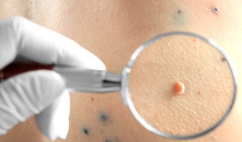 HPV nedir, hangi hastalıklara yol açar?