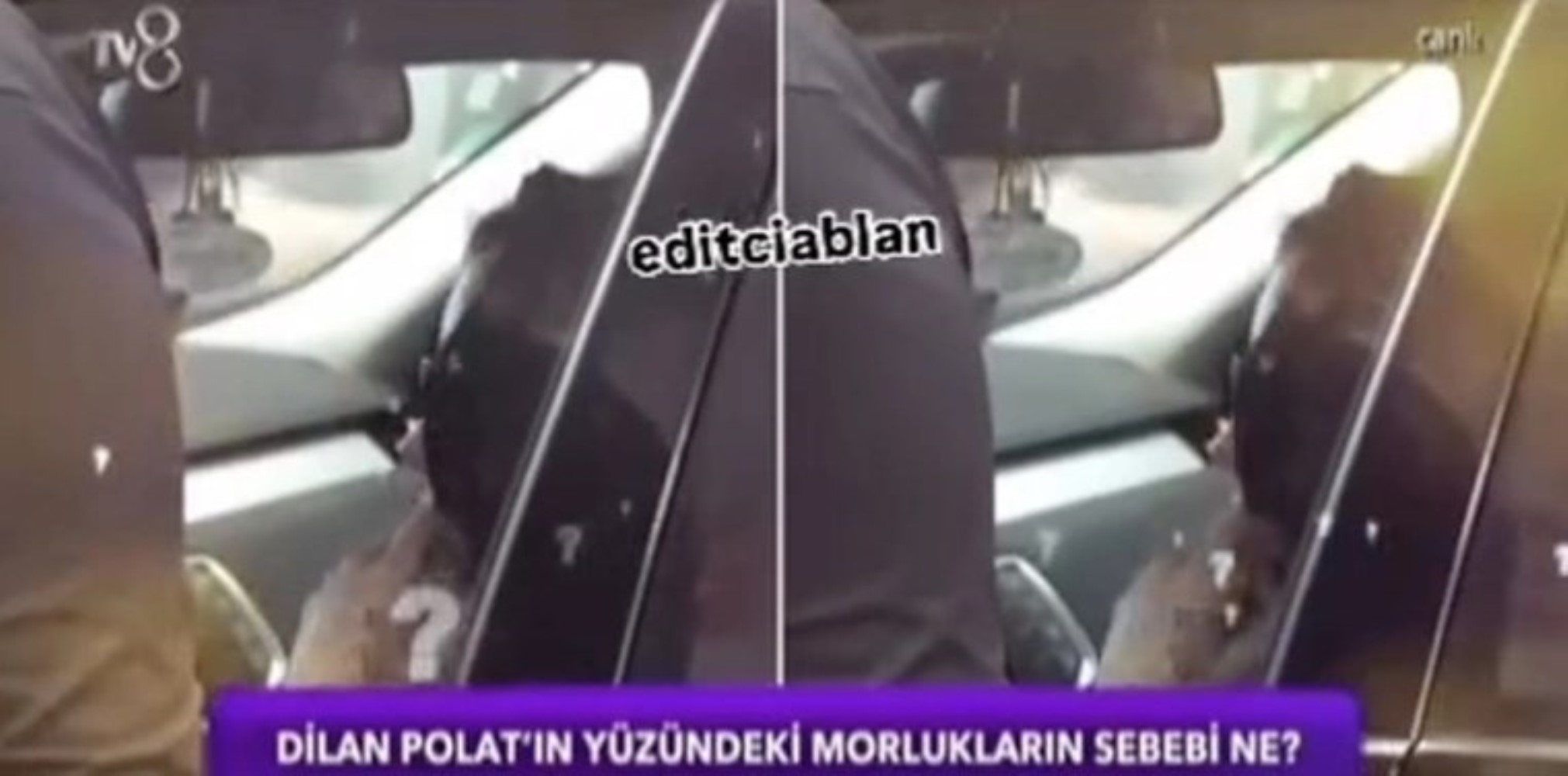 Gizlemek için sık sık gözlük takıyordu: Dilan Polat'ın yüzündeki morlukların sebebi ortaya çıktı