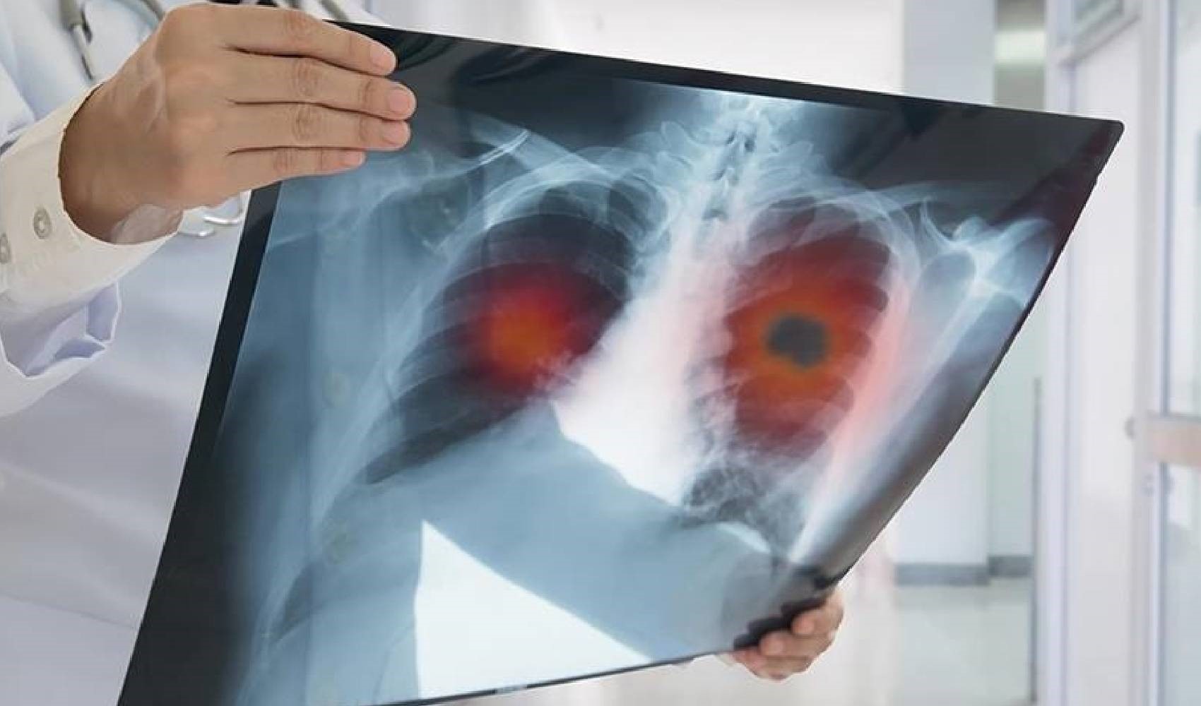 Kadınlarda akciğer kanseri vakalarında artış yaşanıyor