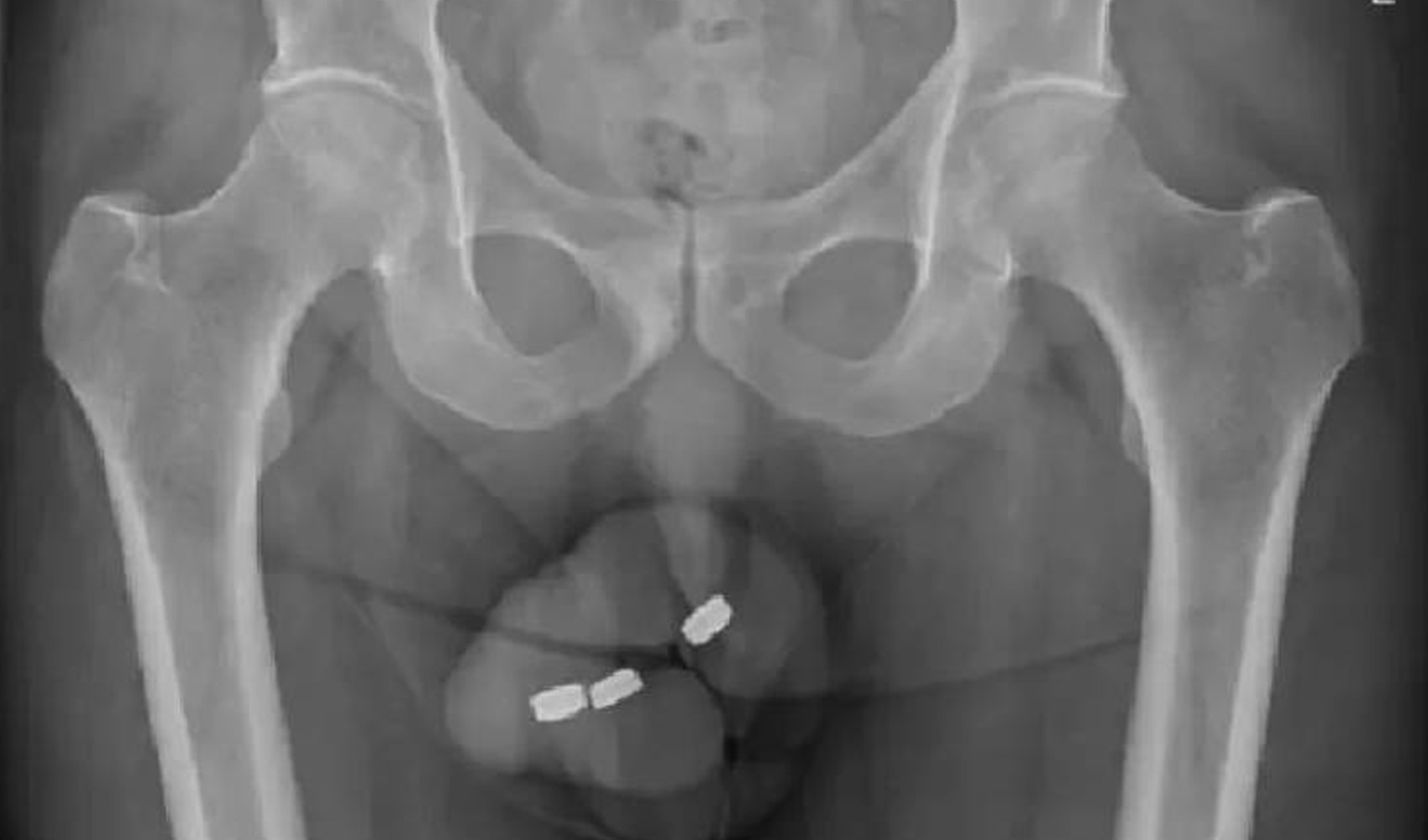 Un caso unico al mondo! Uomo ricoverato dopo essersi inserito delle pile nel pene
