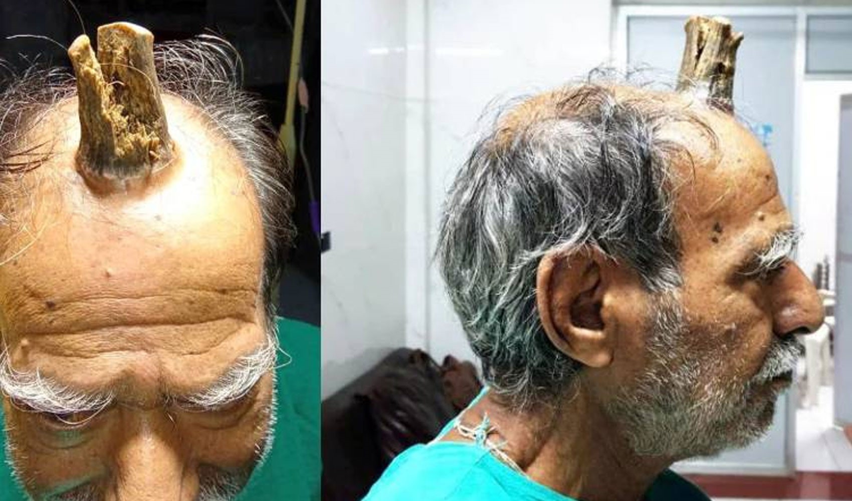 Hindistanlı çiftçinin başına gelenler doktorları hayrete düşürdü! Kafasını vurduğu yerde boynuz çıktı