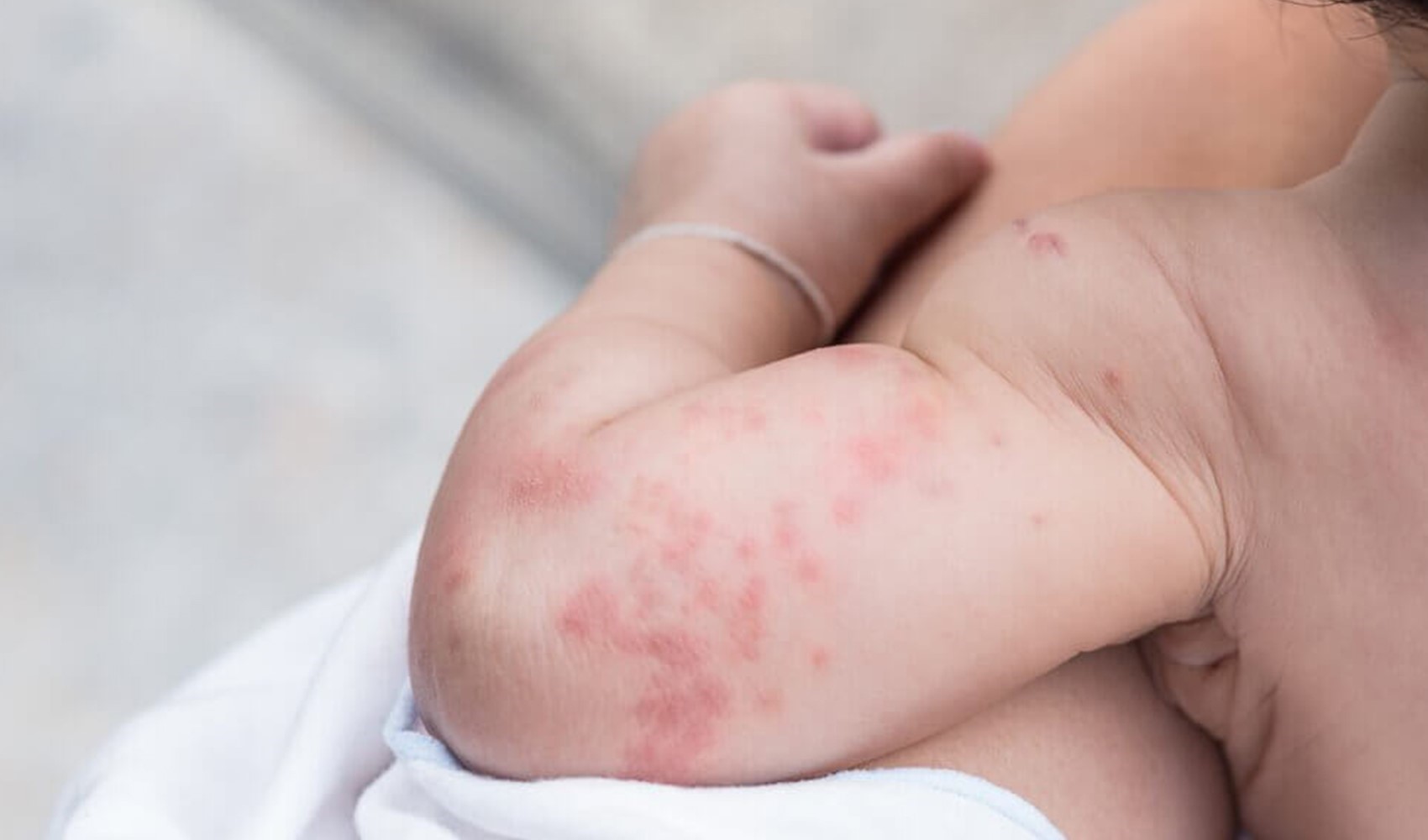 Ecco come prevenire l'eritema da pannolino