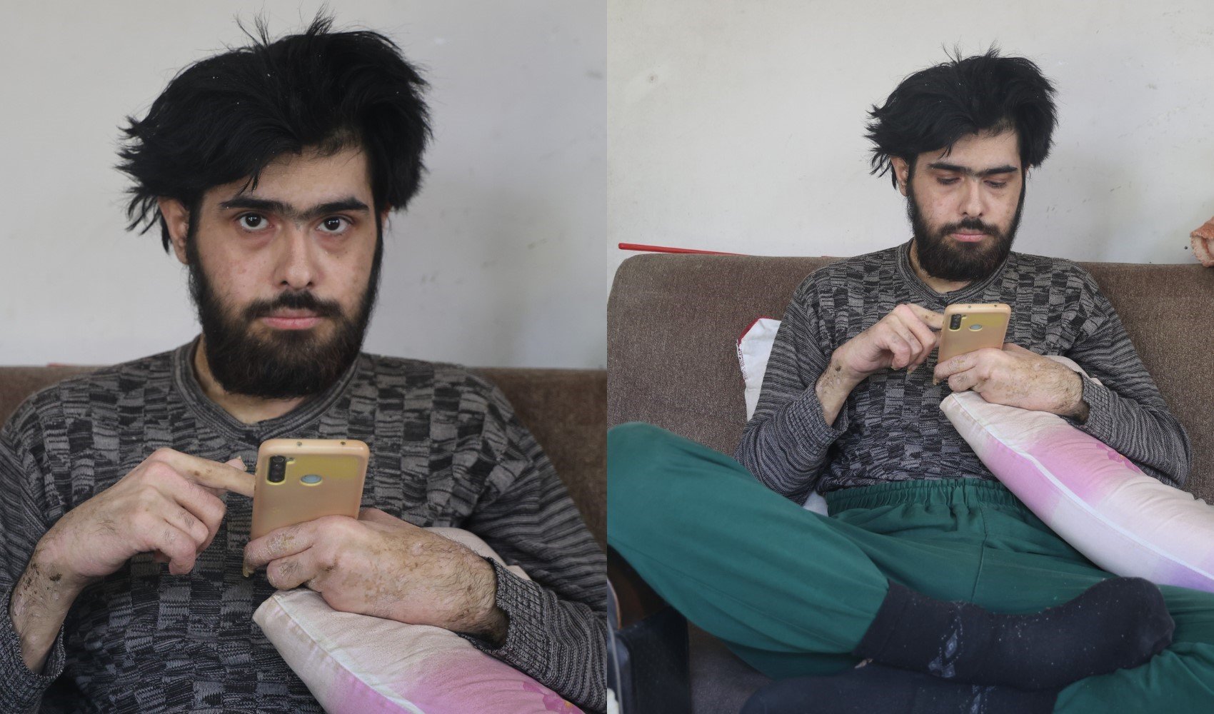 Deprem felaketinin ardından depresyona girdi: 3 yıldır banyo yapmıyor, dışarı çıkmıyor, tırnaklarını kesmiyor