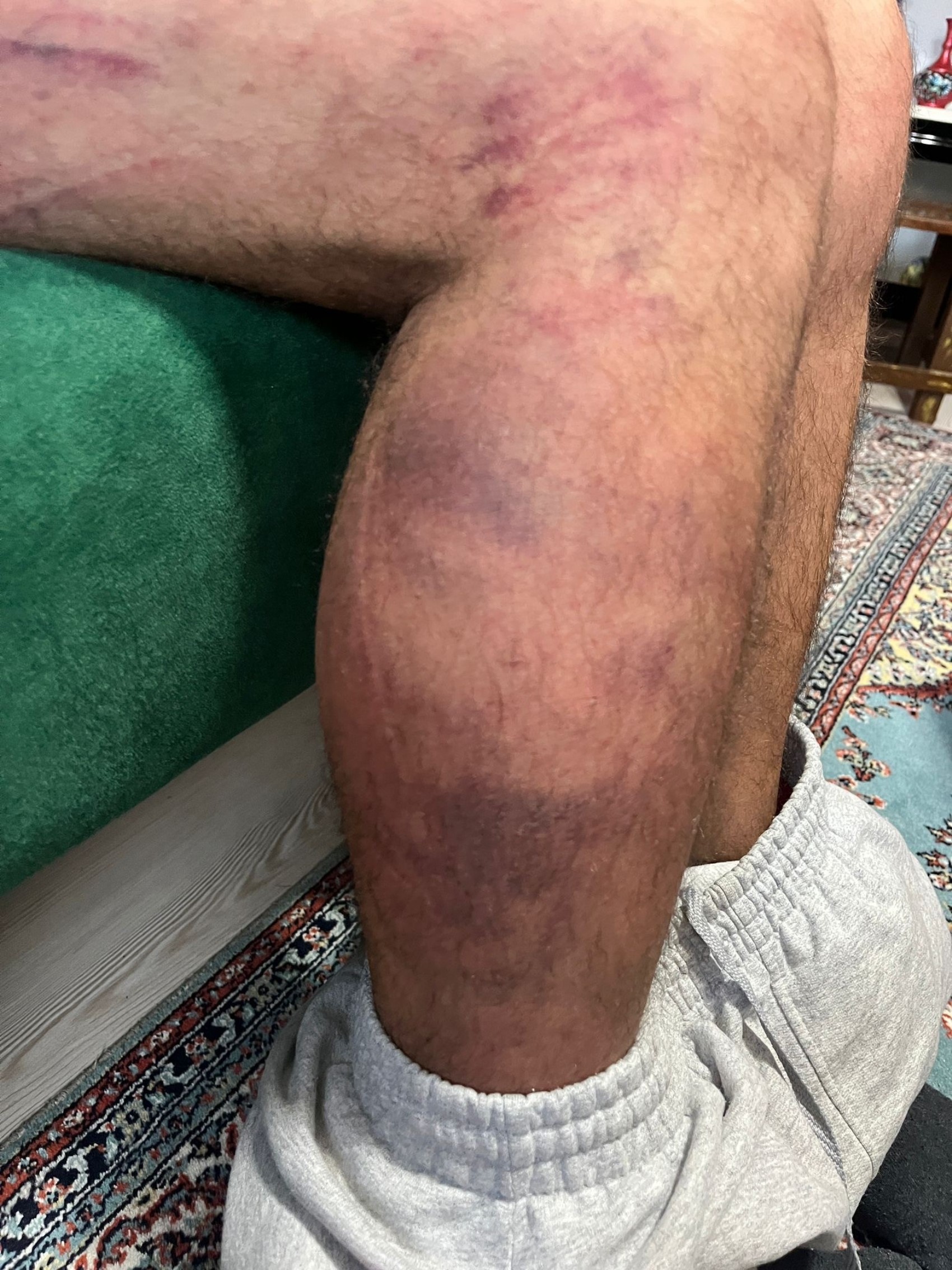 Otizmli şahıs odunluğa baktı diye odunla darbedildi