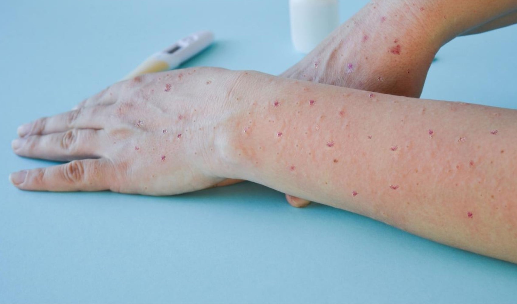 M çiçeği virüsü hızla yayılıyor: Yeni bir varyantı tespit edildi