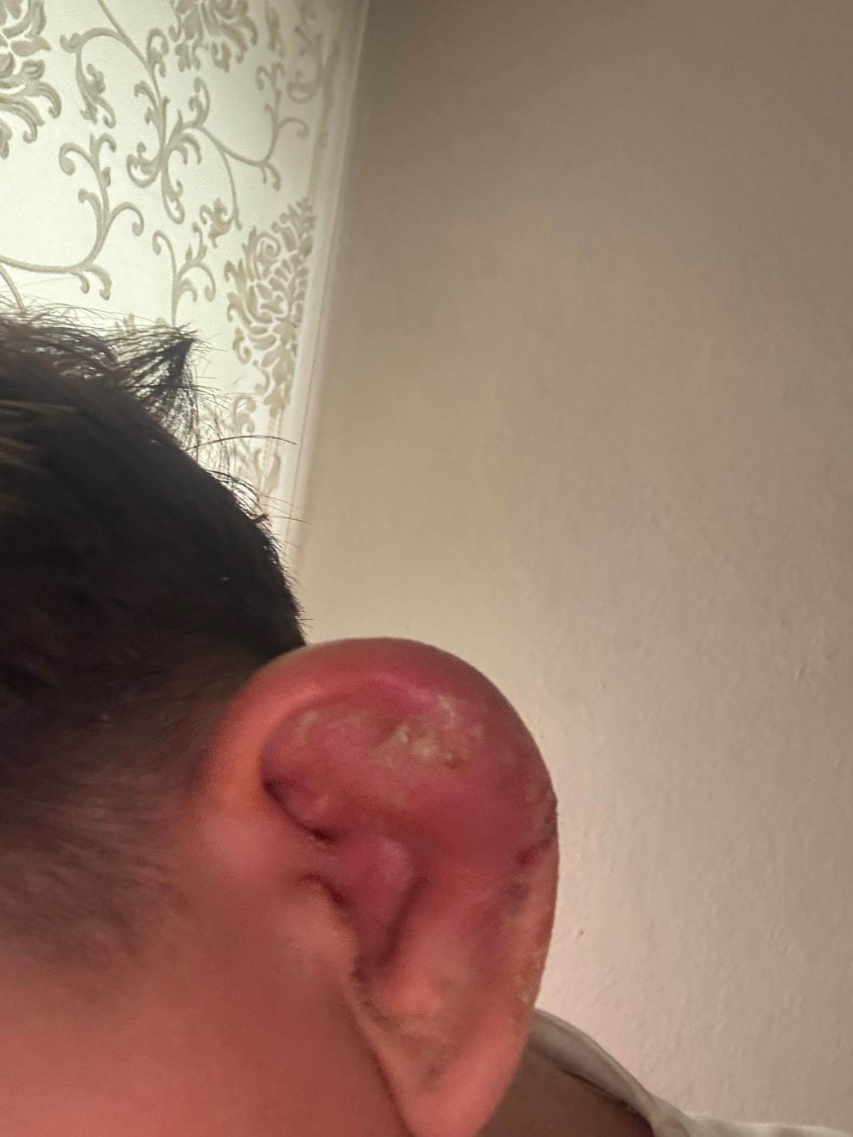 Piercing kabusu: Kulağı şişen 17 yaşındaki çocuk hastanelik oldu
