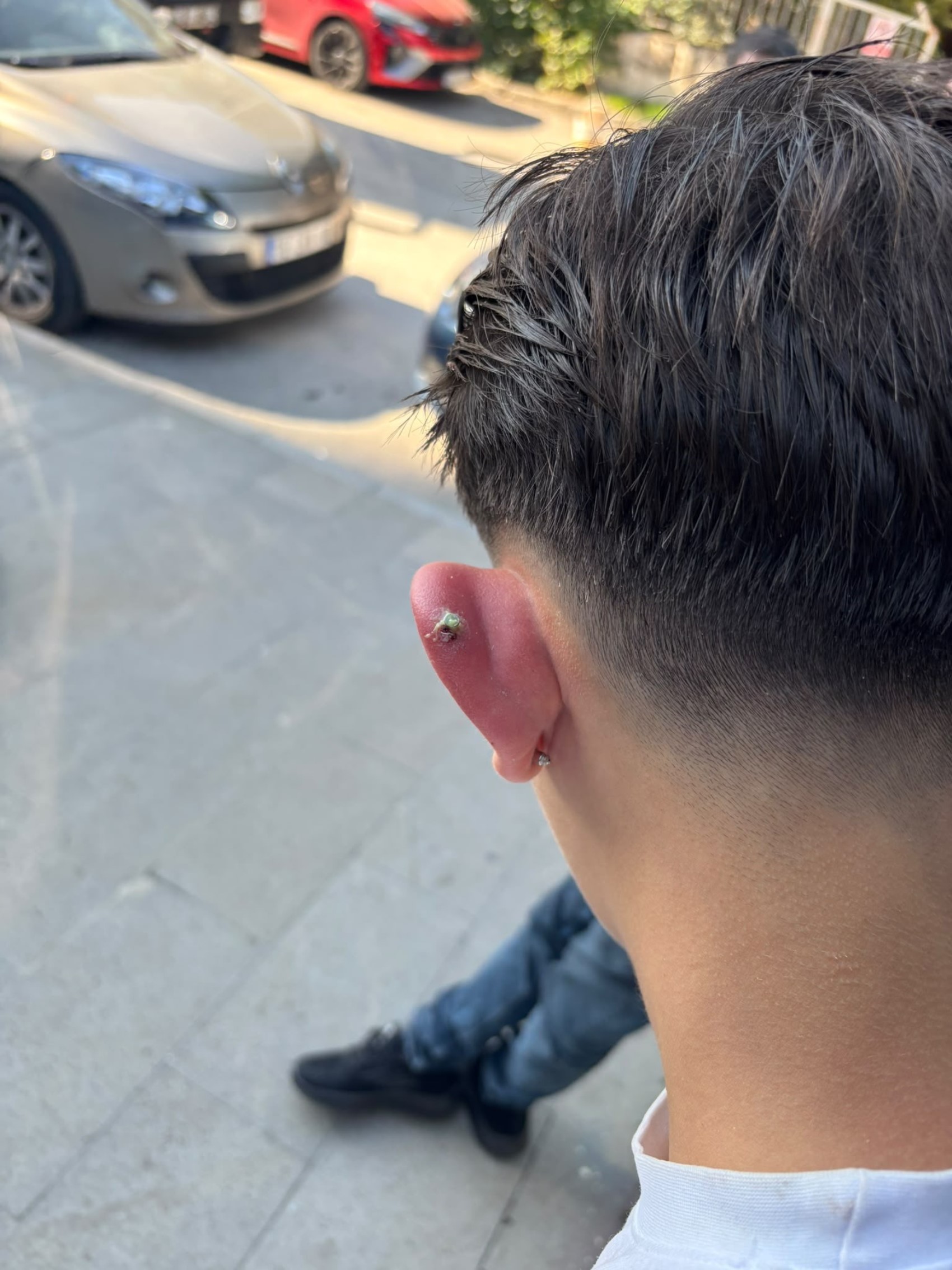 Piercing kabusu: Kulağı şişen 17 yaşındaki çocuk hastanelik oldu