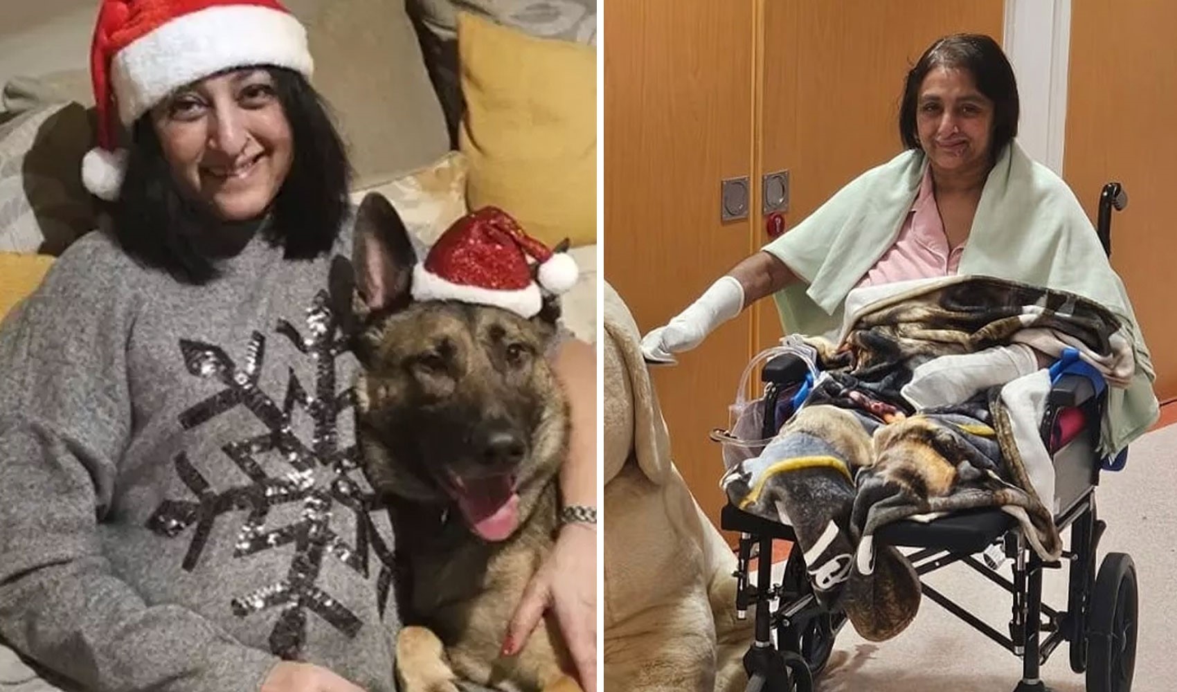 Köpek yalaması sonrası komaya girdi, uzuvlarını kaybetti