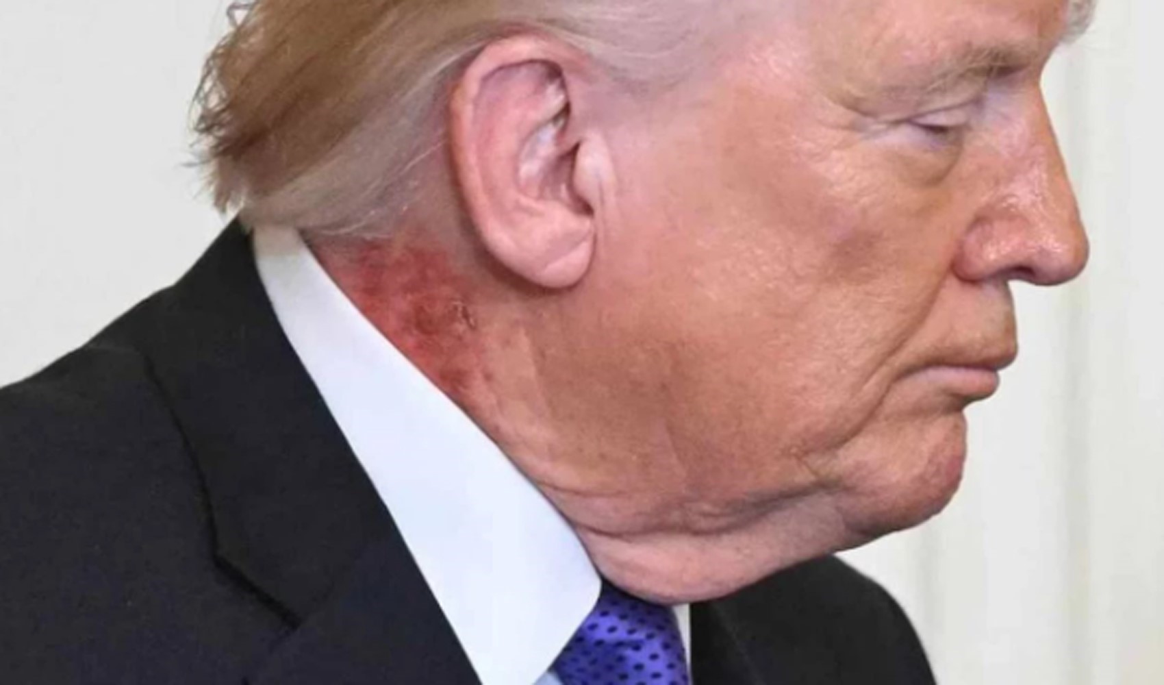 Trump’ın boynundaki kızarıklık hakkında doktorundan açıklama
