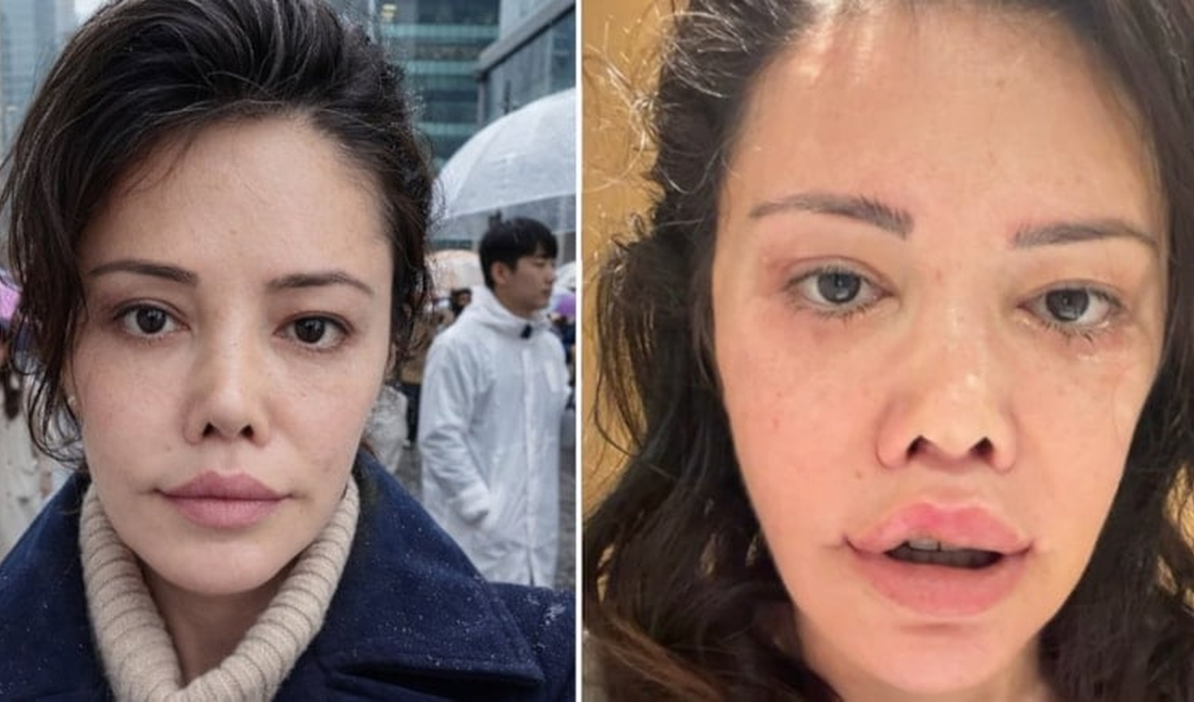 Didem Ceran Kore’deki yüz ameliyatı sonrası yeni görünümünü paylaştı