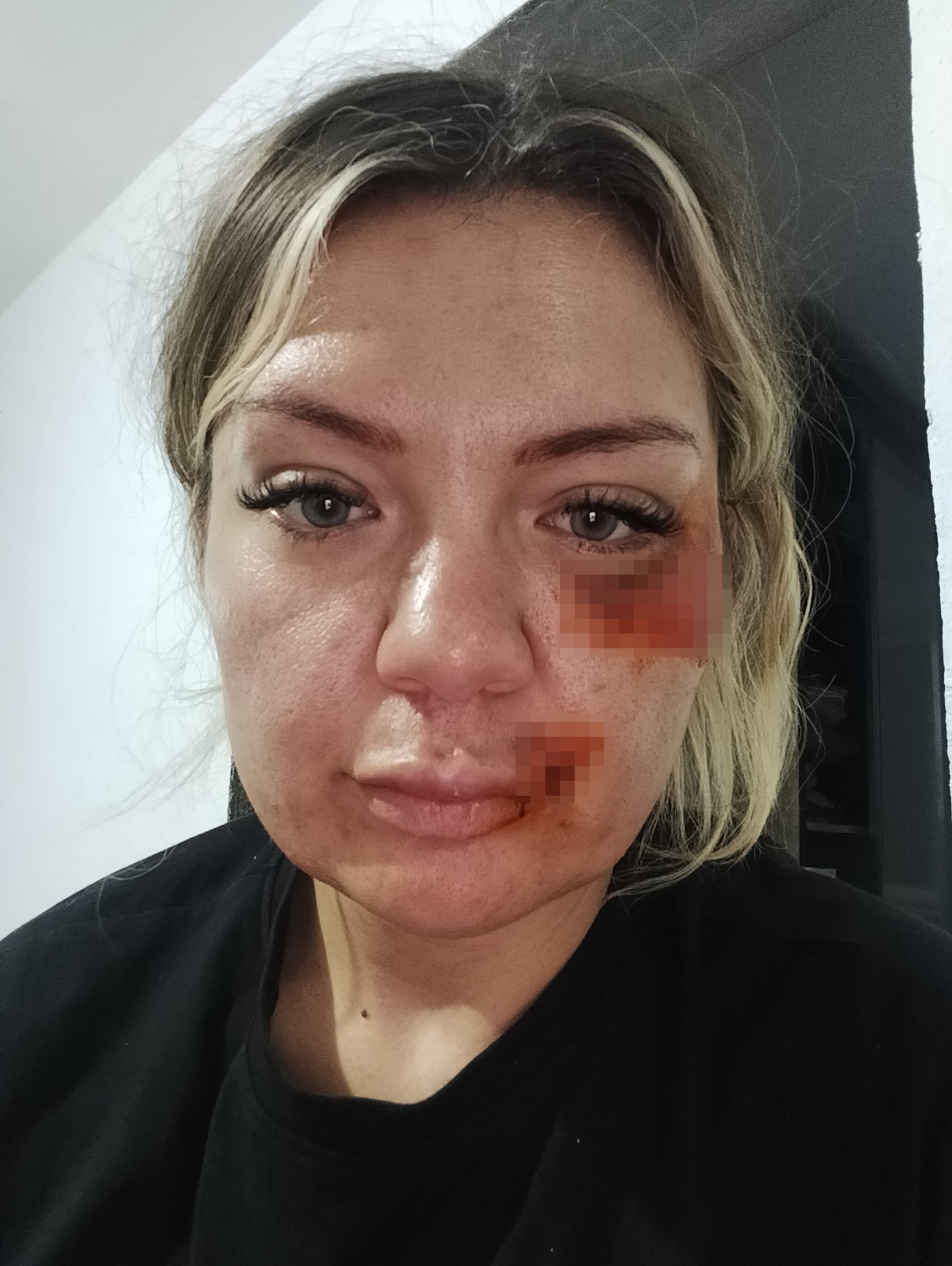 Eski sevgilisi saldırdı: Bıçak kırılmasaydı yaşama şansım yoktu