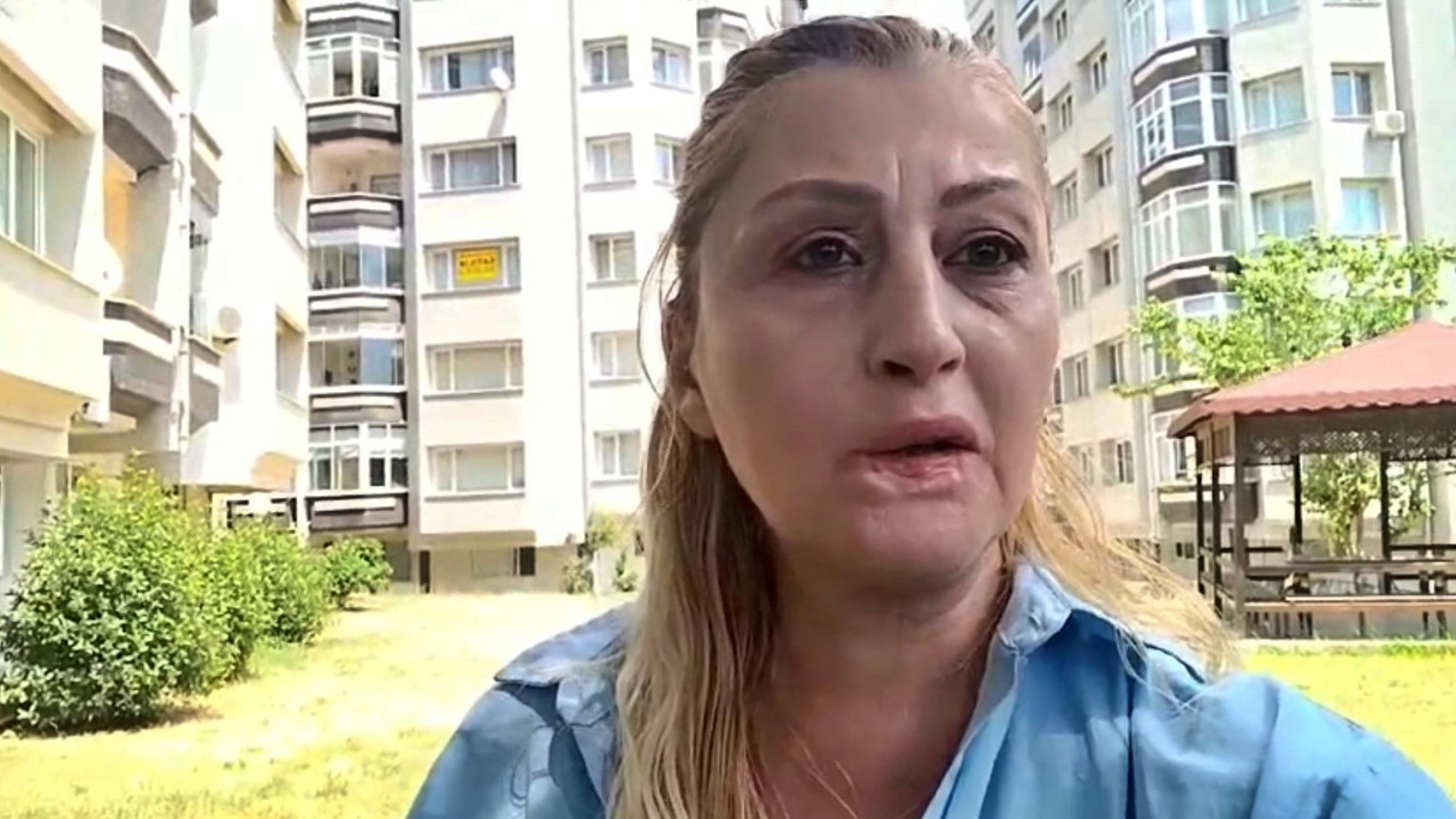 Estetik işlem sonrası dudağı çürüdü