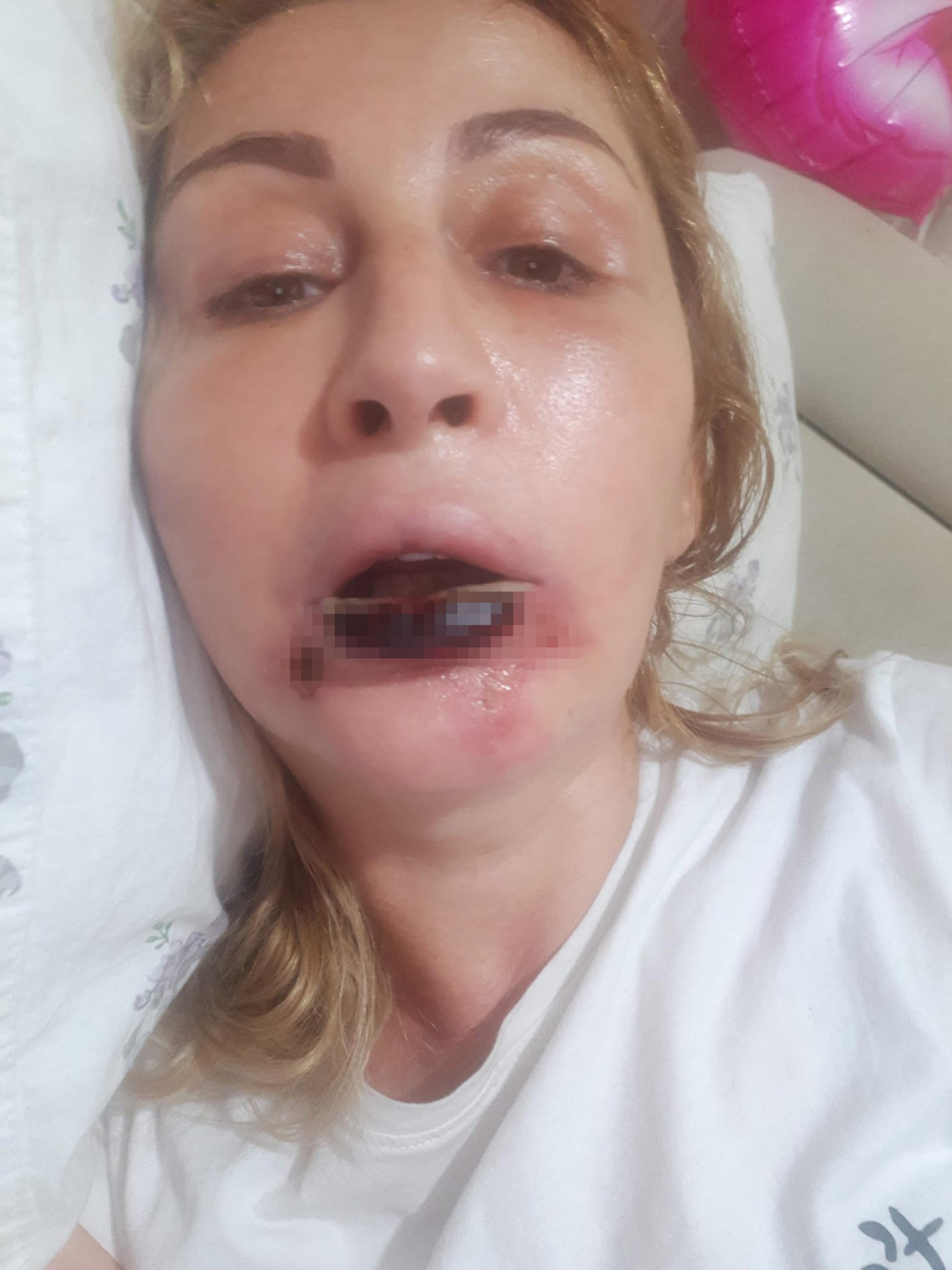 Estetik işlem sonrası dudağı çürüdü