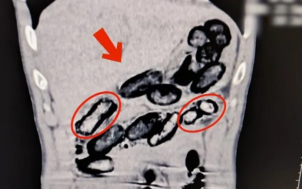 Şüphelilerin vücudunda uyuşturucu madde bulunduğunu gösterdiği belirtilen tomografi görüntüsü